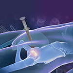 Orthobiologics for the Hip