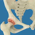 Osteoarthritis of the Hip